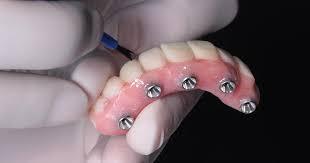 all on 4 dental implant