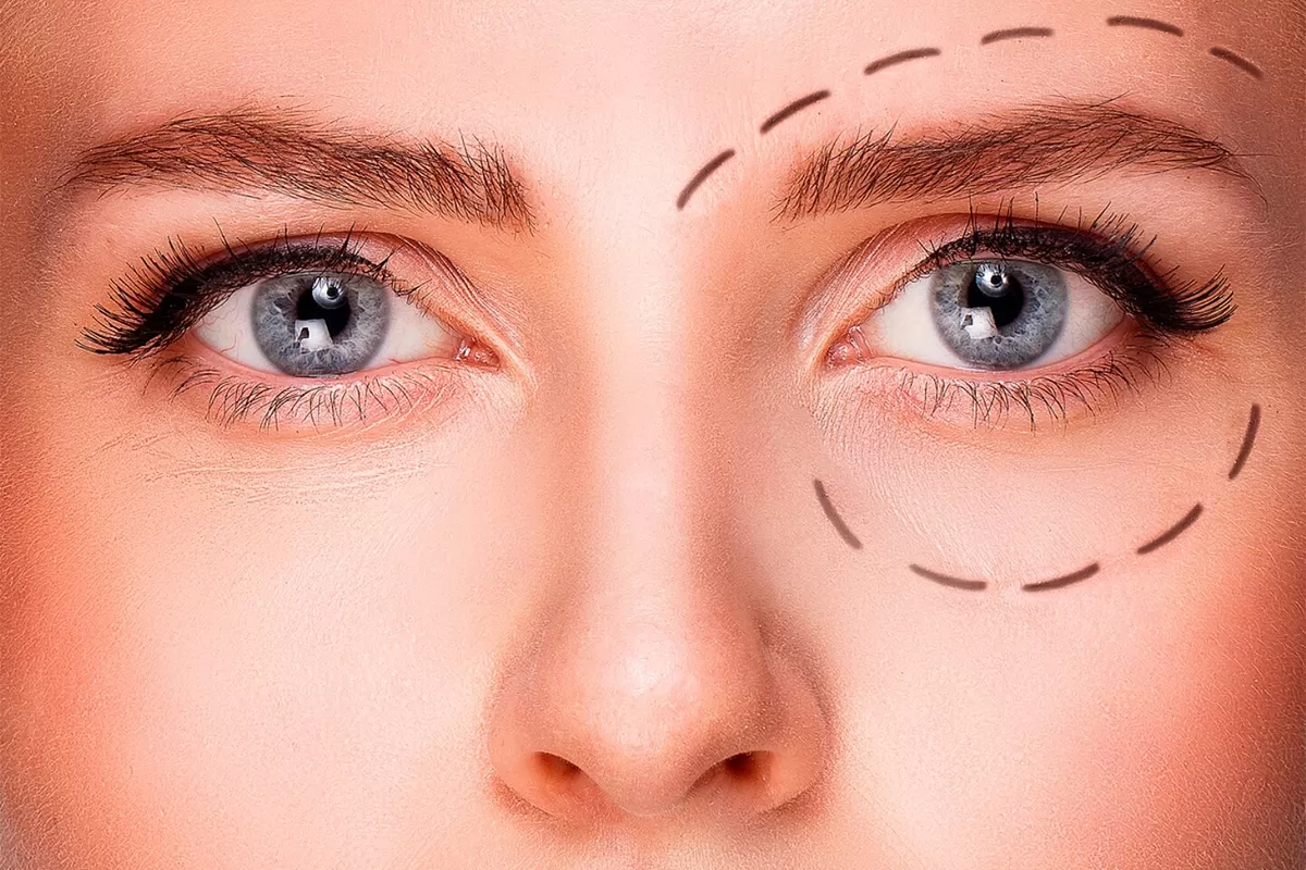 Blepharoplasty for Droopy Eyelids (Ptosis)