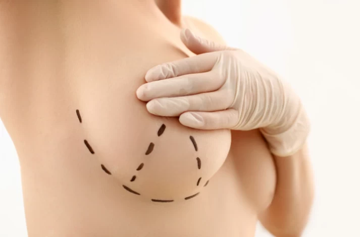 Preparing for Breast Enhancement Surgery: A Step-by-Step Guide