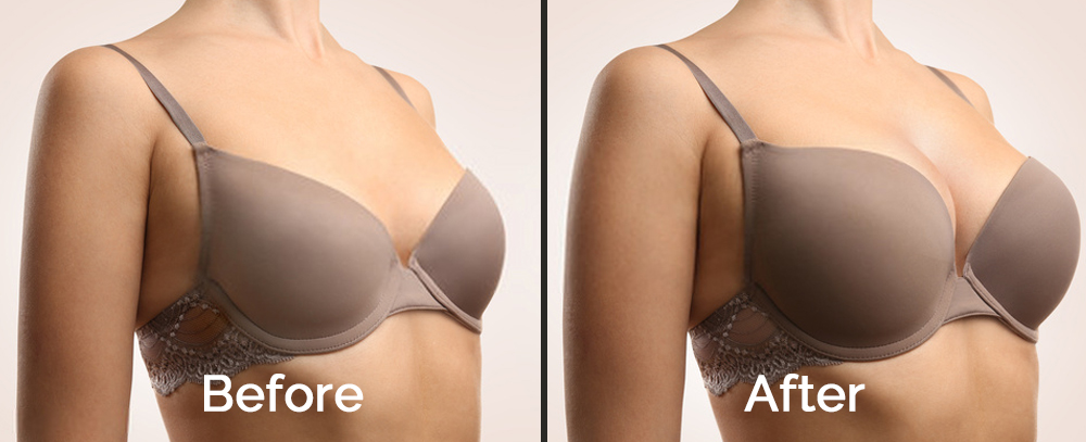 How to Evaluate Before-and-After Photos of Breast Augmentation in Dubai