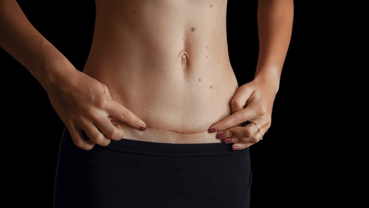 Achieve A Flatter Tummy With Mini Abdominoplasty In Dubai