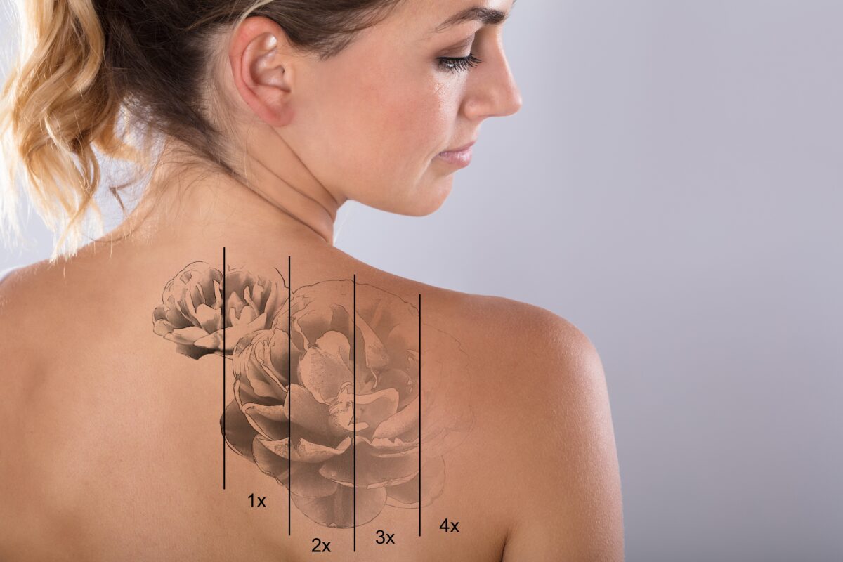 Laser,Tattoo,Removal,On,Woman's,Shoulder,Against,Gray,Background