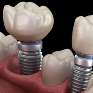 dental implants Mascot