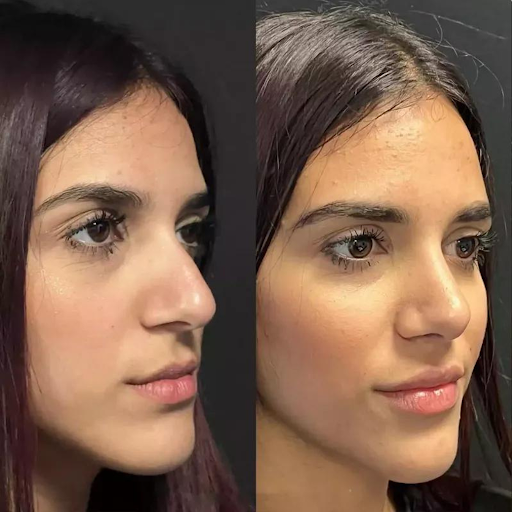 Rhinoplasty in Dubai: Transforming Your Look with Precision and Expertise