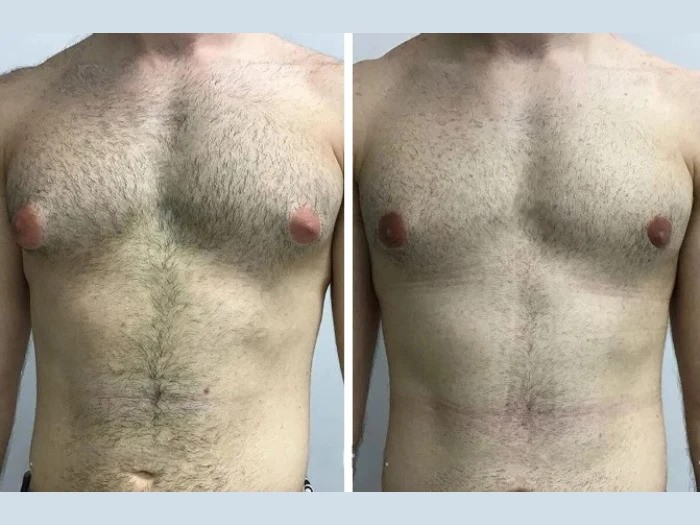 Best Gynecomastia Surgeon in Dubai