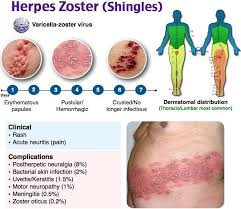 herpes zoster infection