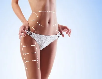 Liposuction in Islamabad