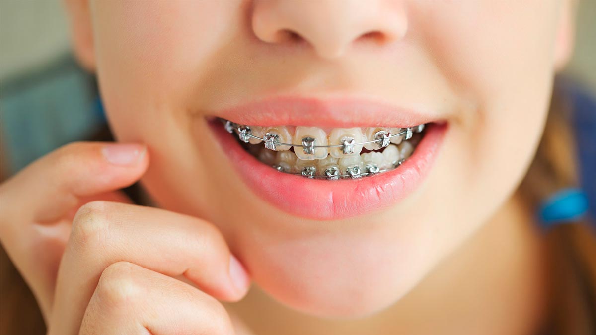Orthodontic Treatment