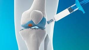 Viscosupplementation Market