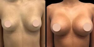 Breast augmentation in dubai