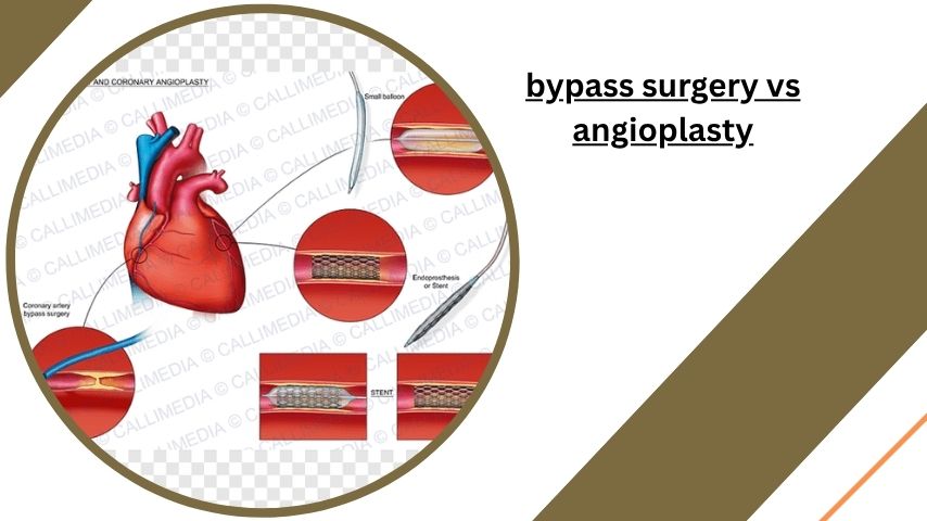bypass surgery vs angioplasty
