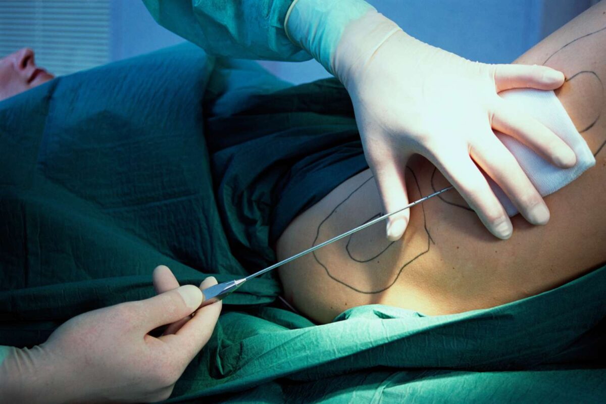liposuction in islamabad