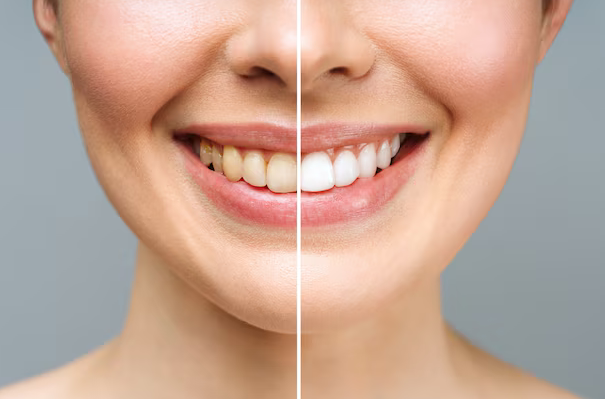 teeth whitening katy tx