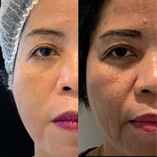 How the Best Doctors in Dubai Achieve Flawless Thread Lift Outcomes