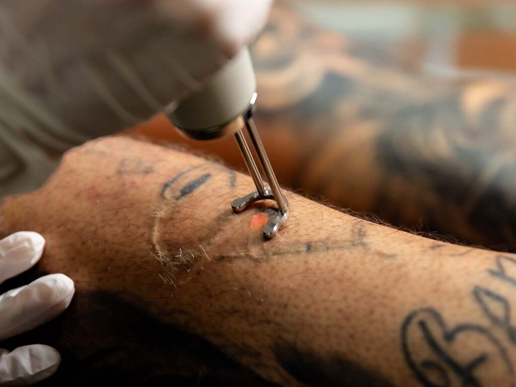 Laser Tattoo Removal in Dubai