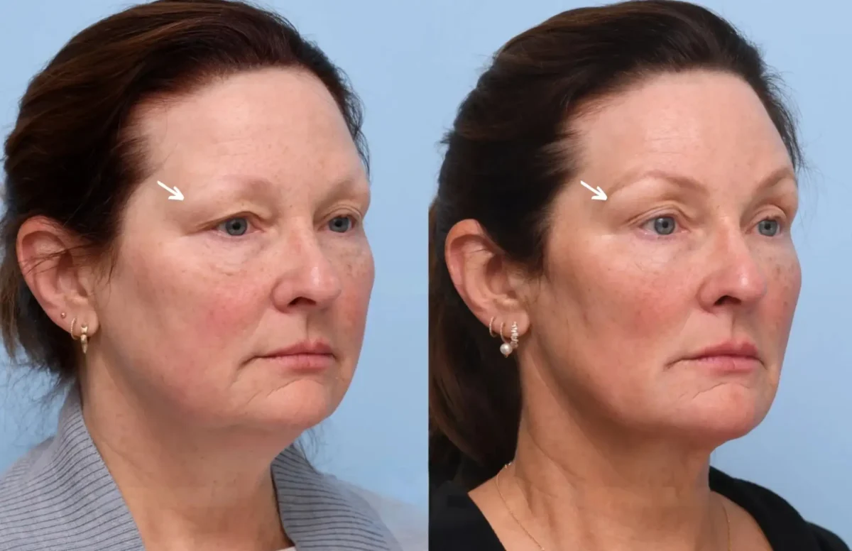 Best Aesthetic Clinics in Dubai for Botox: Get Smooth Skin Without Surgery