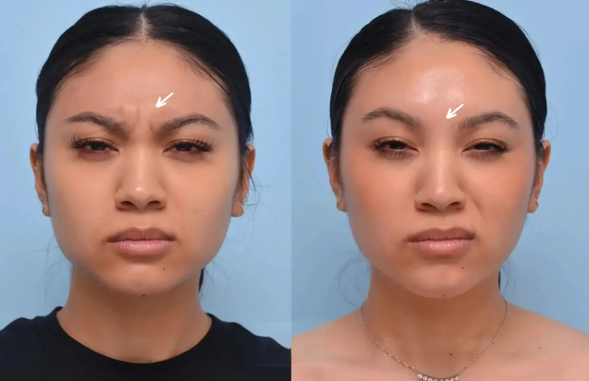 botox in dubai