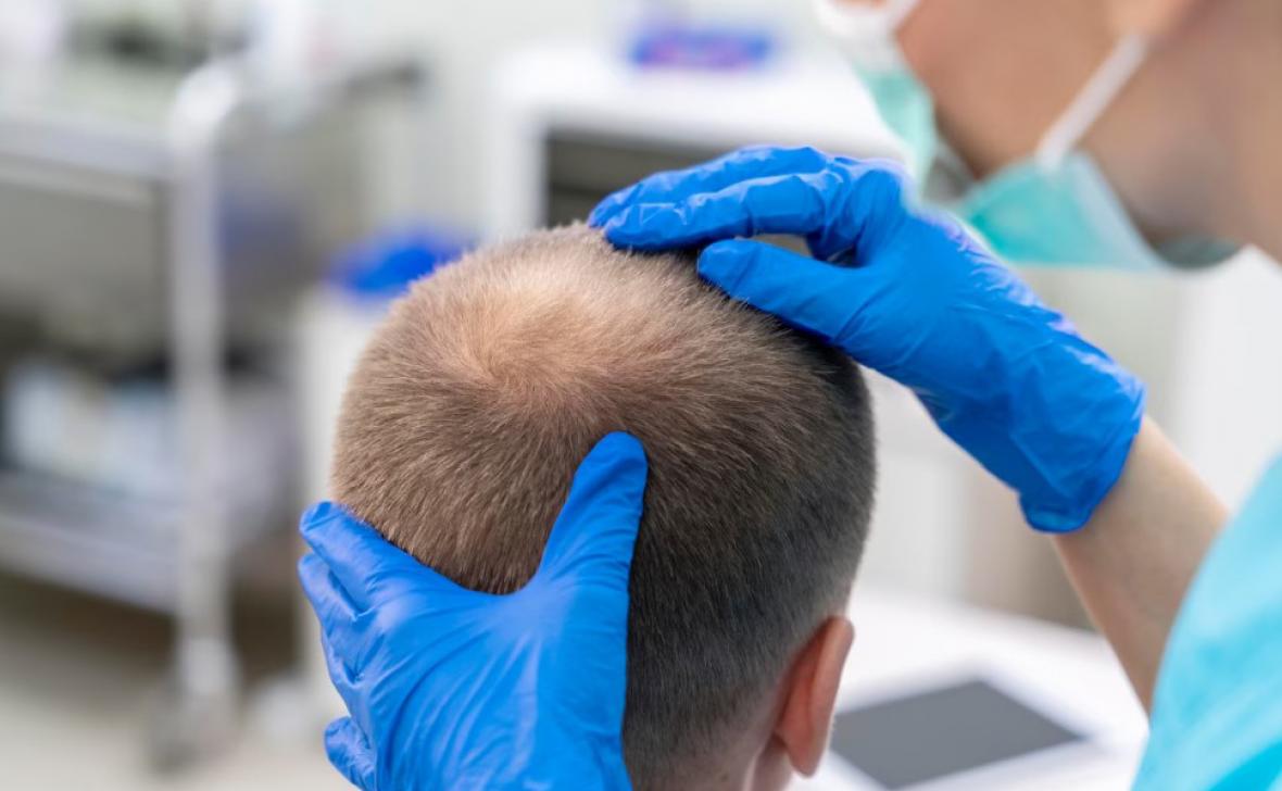 Hair Transplant in Dubai