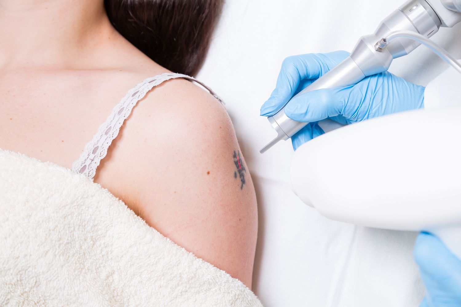 Laser Tattoo Removal in Dubai
