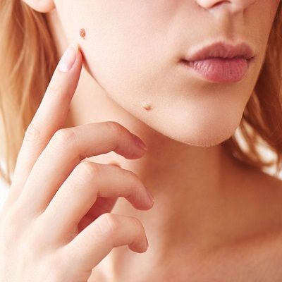 Mole Removal Islamabad,