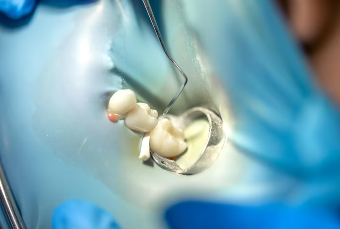 dental fillings carmel in
