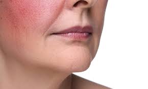 Rosacea Treatment