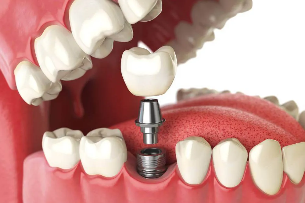 impianto dentale a Tirana / miglior clinica dentale albania