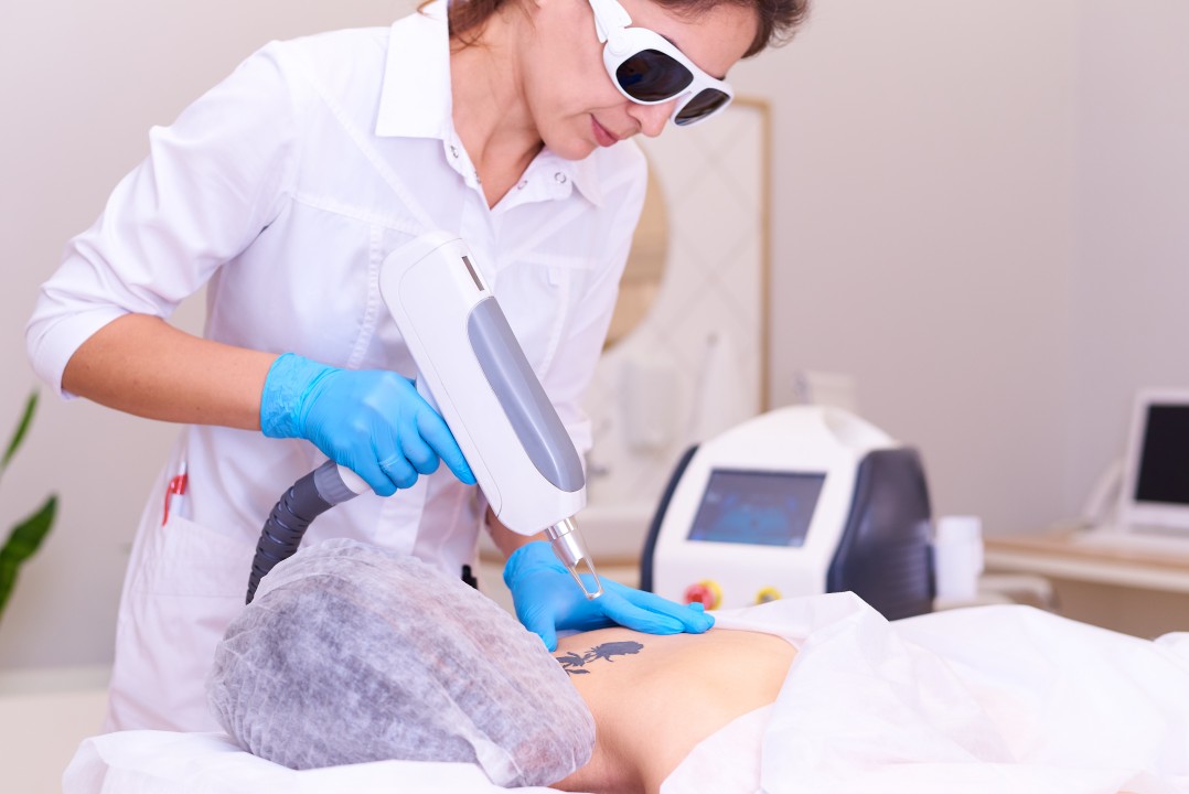 Laser Tattoo Removal in Dubai