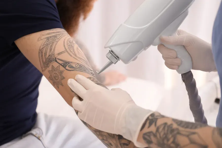 Laser Tattoo Removal in Dubai