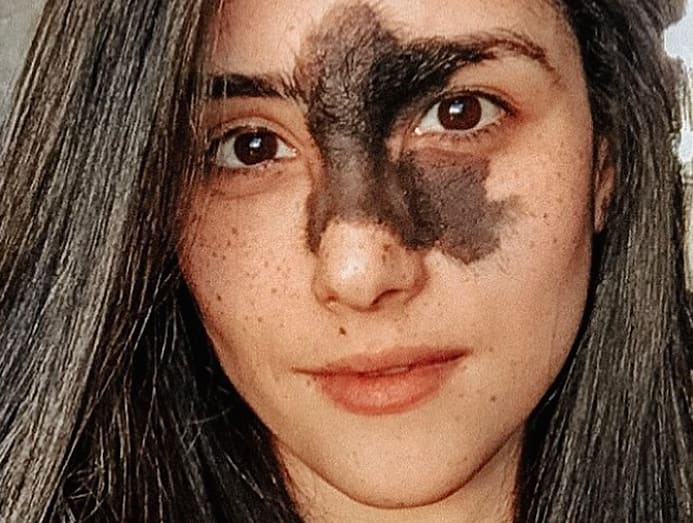 Can Birthmarks Be Treated in One Session?