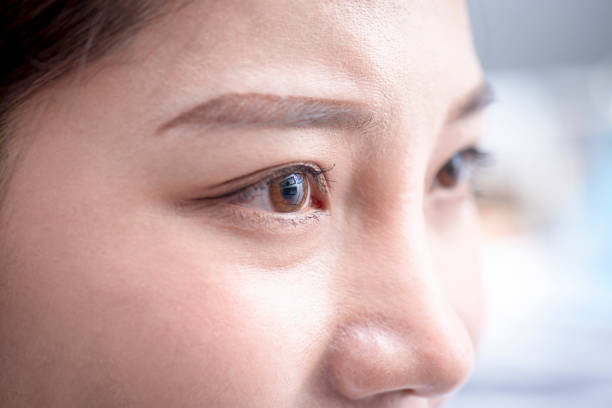 Eyelid Surgery in Riyadh