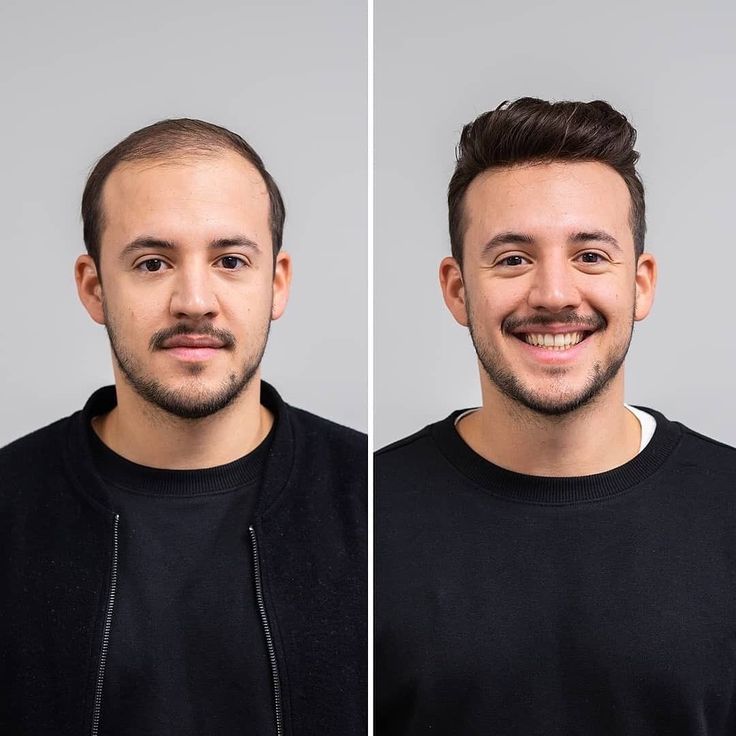 FUE Hair Transplant in Riyadh