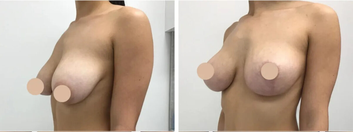 breast lift in dubai
