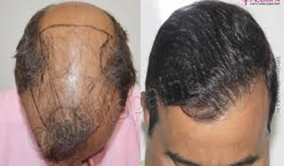 زراعة الشعر في الرياض