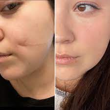 How Soon Can You See Results After Scar Revision Surgery?