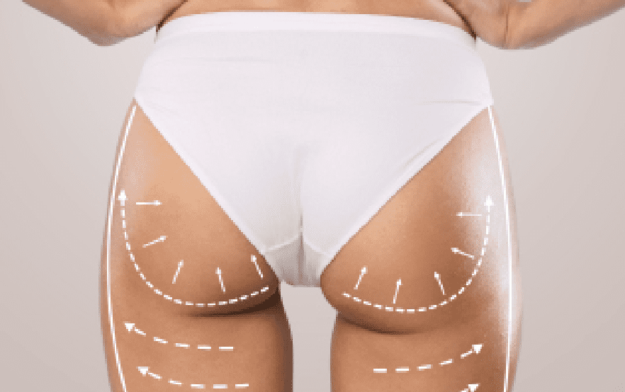 Butt Fat Transfer in Dubai,