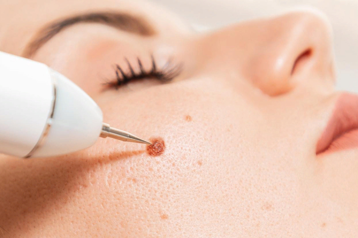Warts Removal in Islamabad