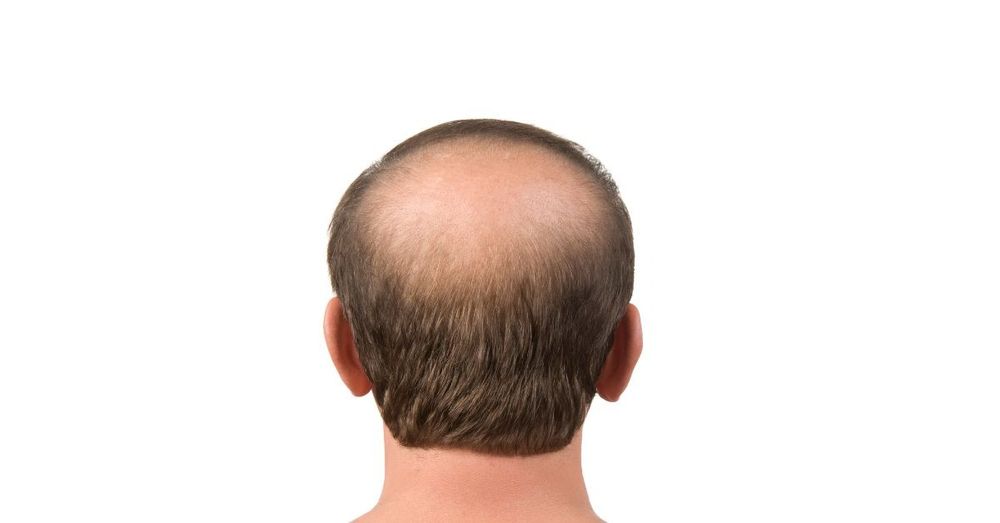 Hair Transplant in Dubai