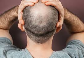 Hair Specialist Doctor in Dubai
