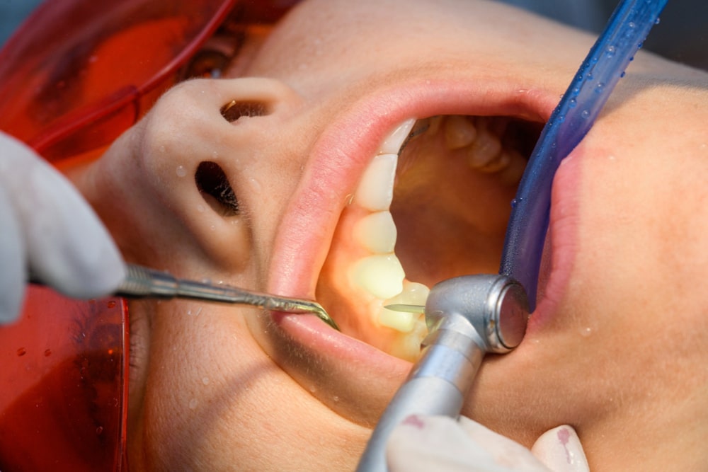 root canal in islamabad