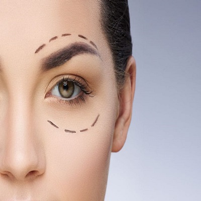 Eyelid Surgery in Islamabad