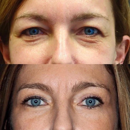 Eyelid