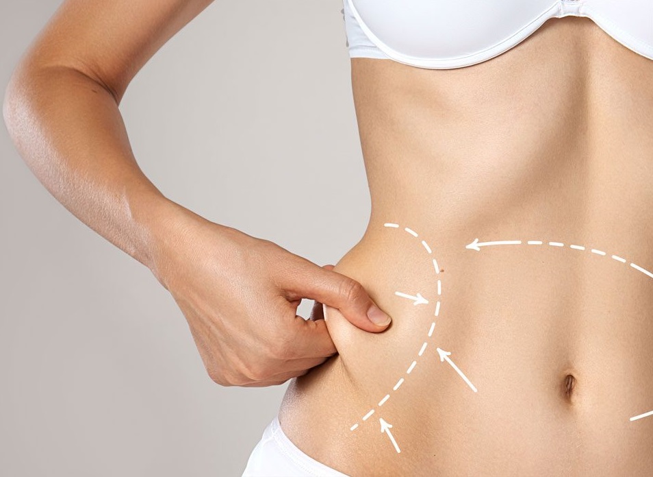 Liposuction in Islamabad