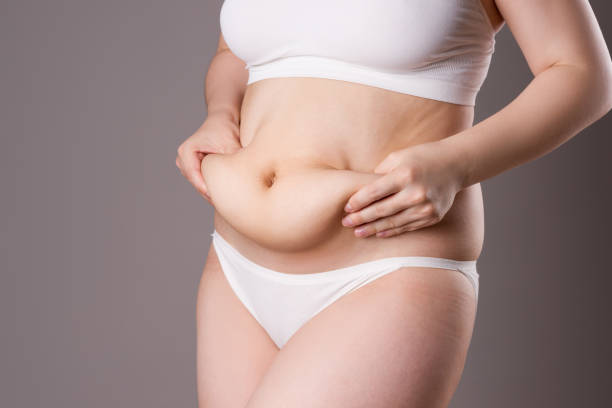 Tummy Tuck in Riyadh