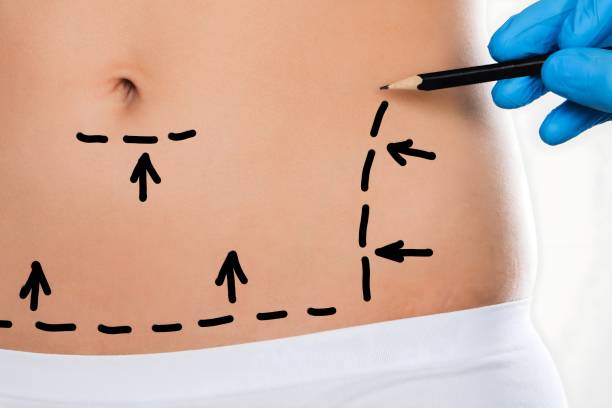 Tummy Tuck in Riyadh