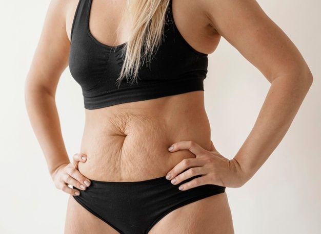Tummy Tuck in Riyadh