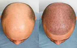 زراعة الشعر في الرياض
