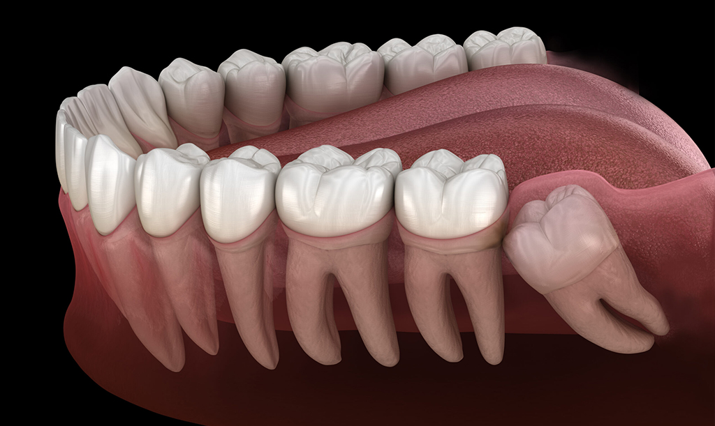 wisdom teeth removal in Nottingham