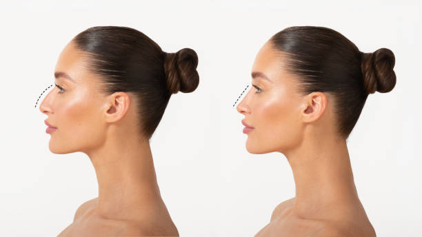تجميل الأنف في الرياض