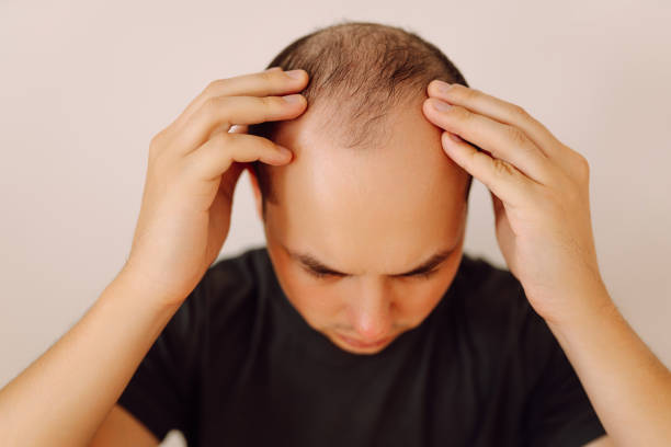 زراعة الشعر في الرياض